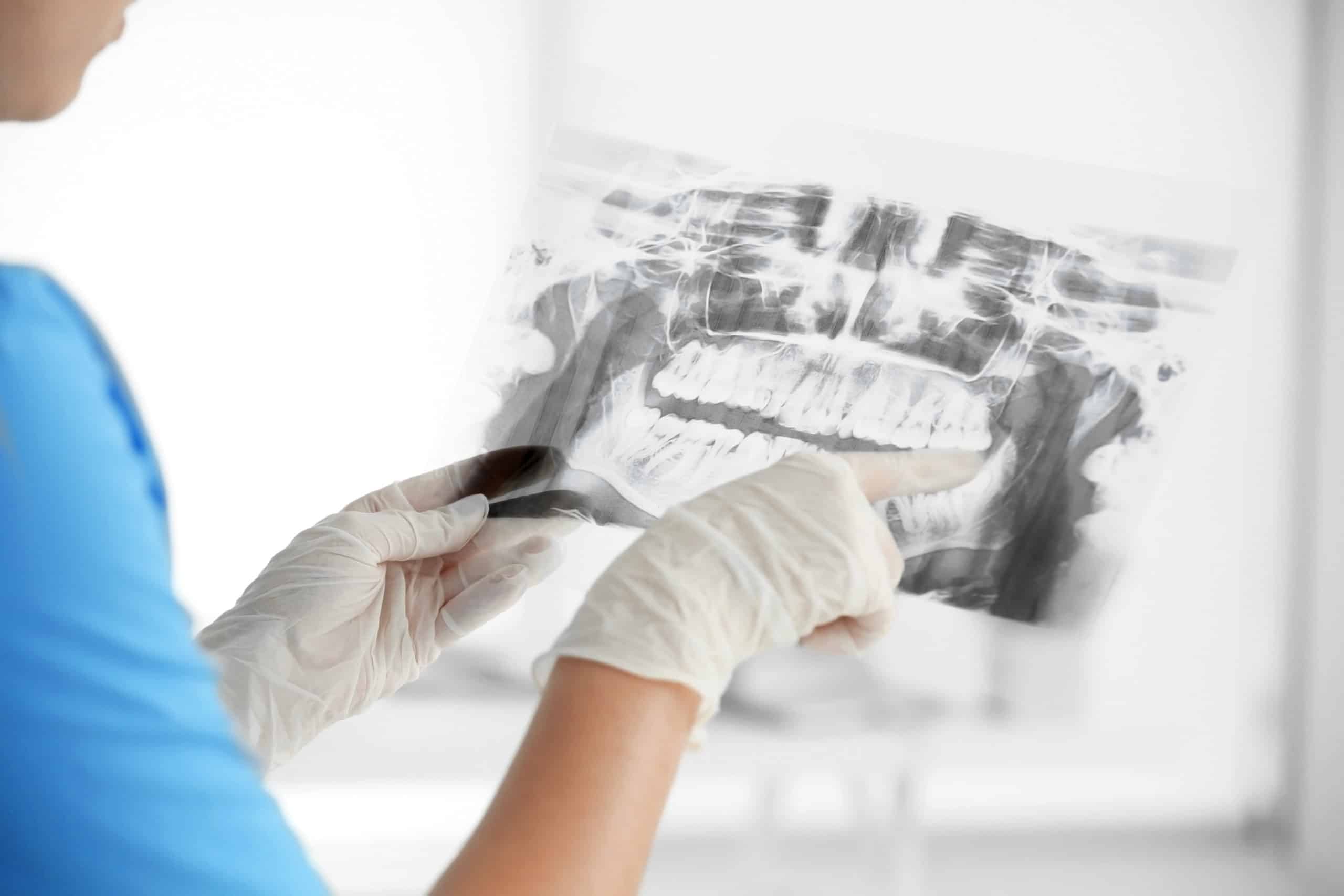 cavity detection VIP Smiles Family Dentistry Syracuse, UT