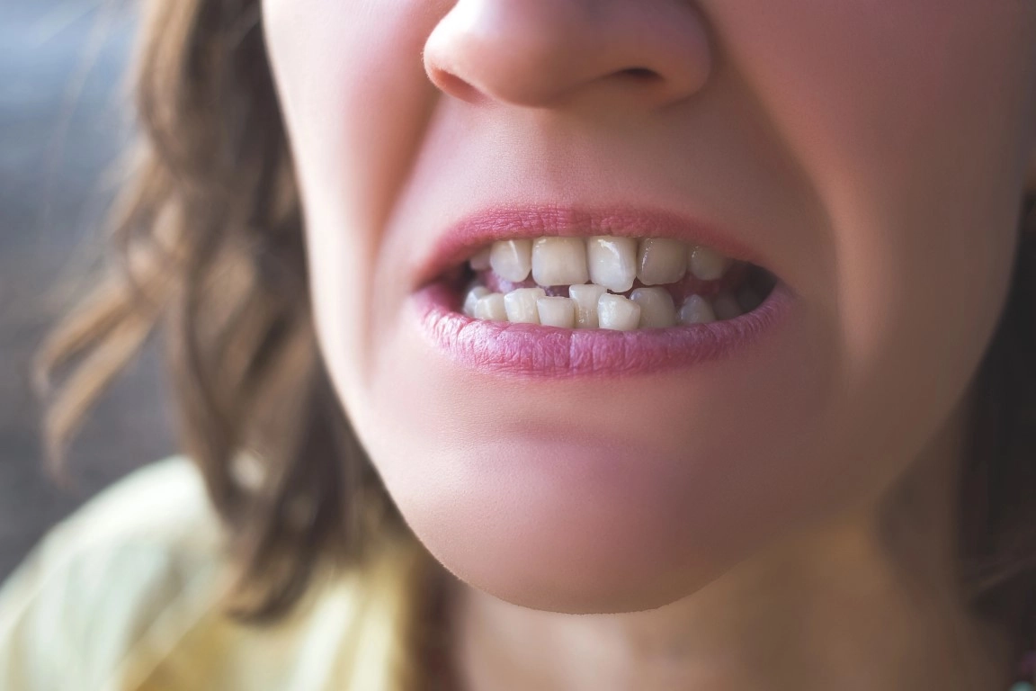 Do You Need Braces To Fix Crooked Teeth? Do You Need Braces to Fix Crooked Teeth?