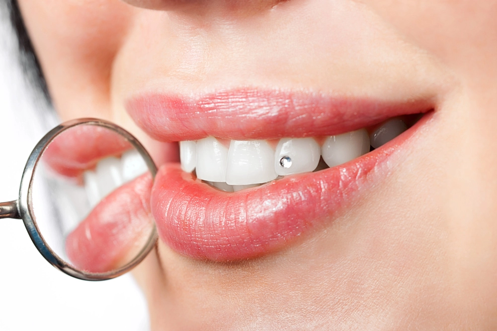 Tooth Gems: Are They A Good Idea? tooth gems