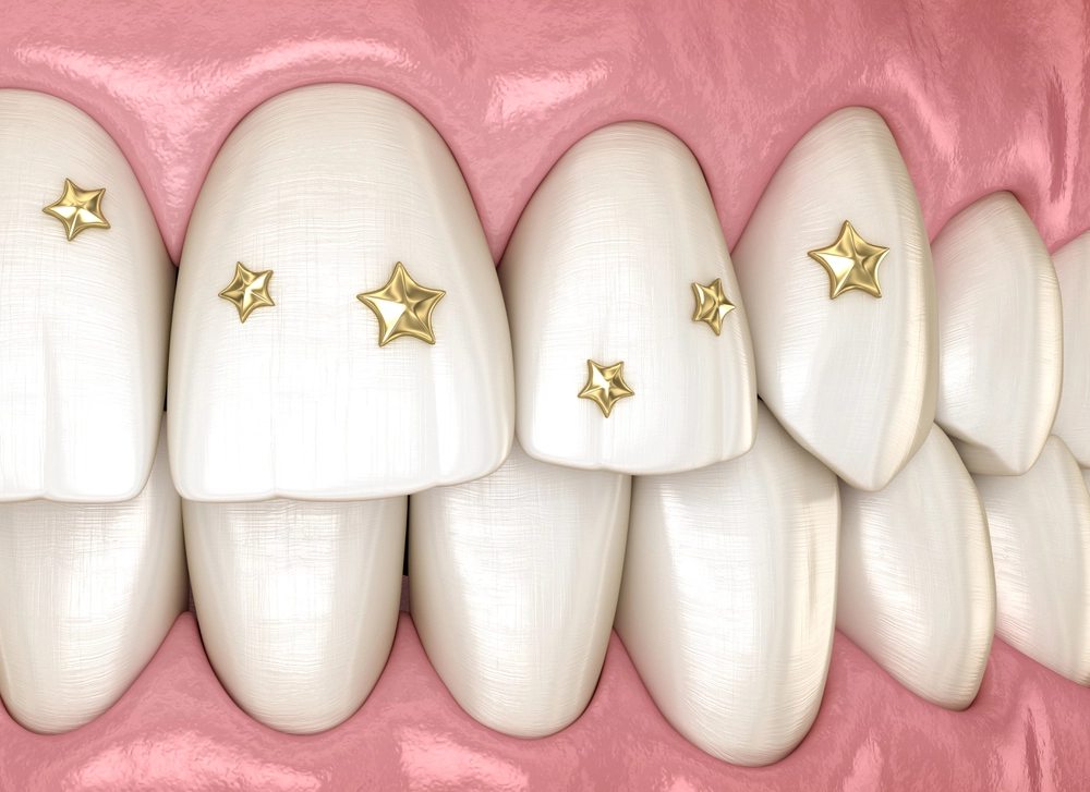 Tooth Gems: Are They A Good Idea? tooth gems