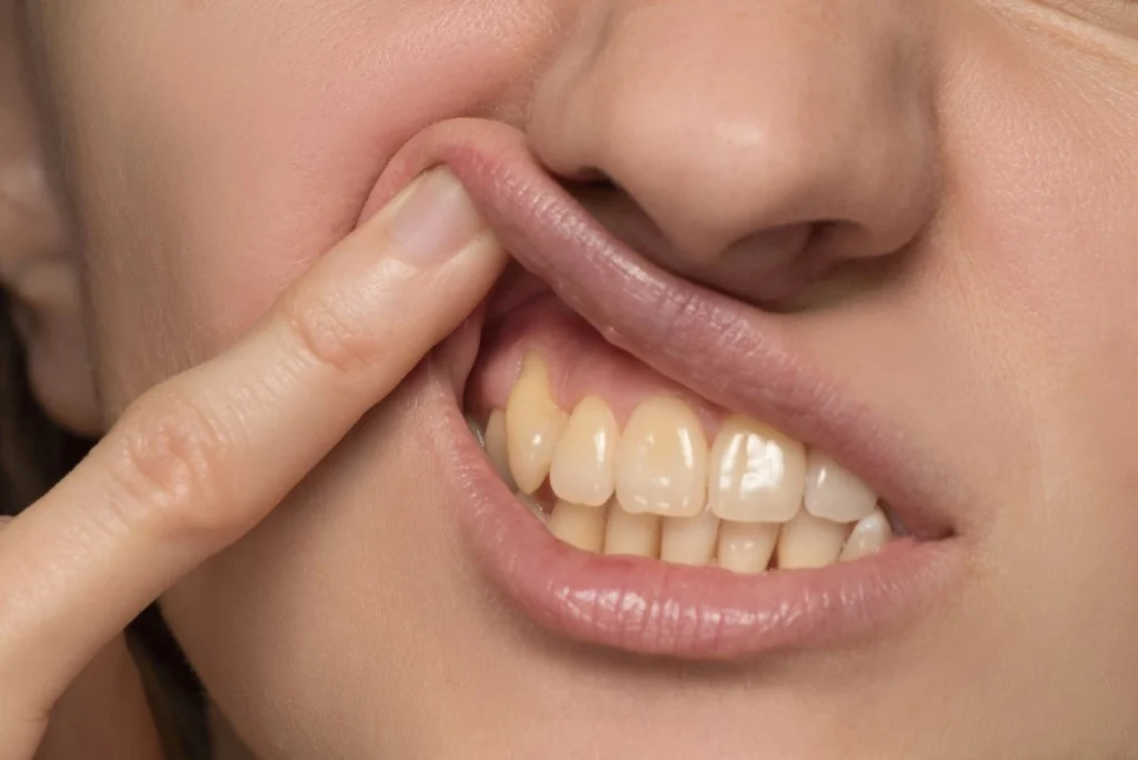 Teeth Stain