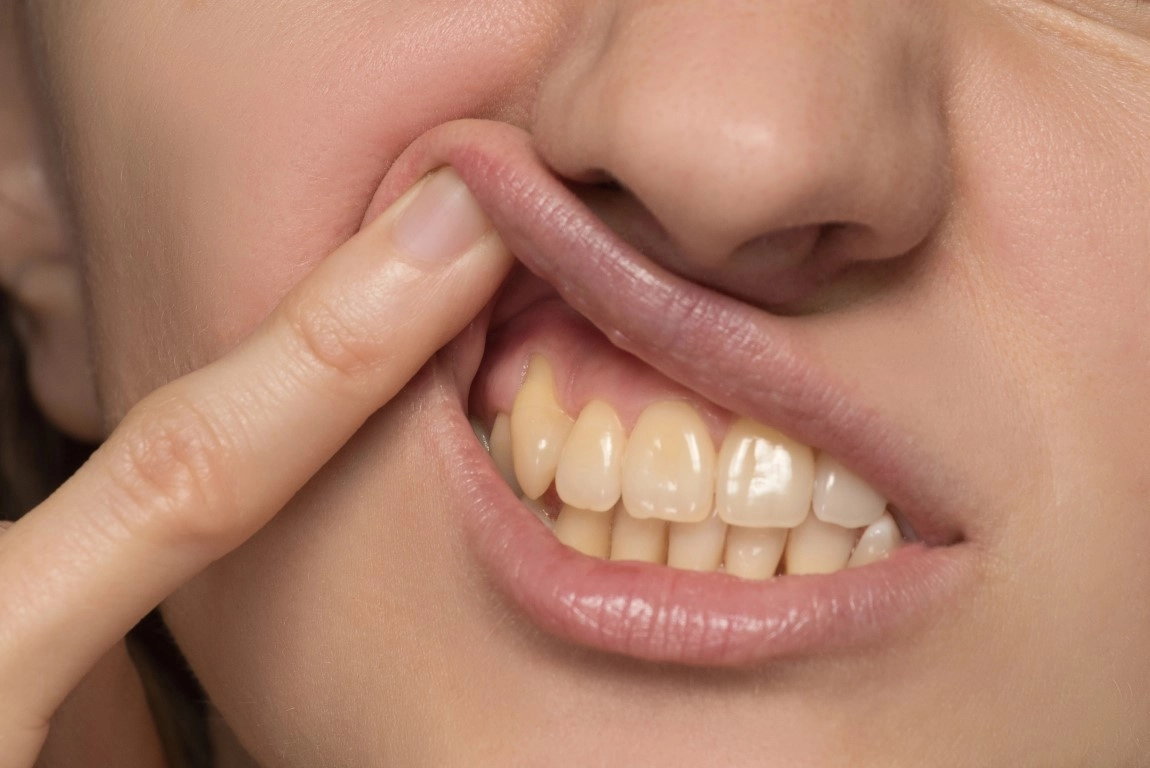 Teeth Staining: Your Guide To Causes, Prevention, And Treatment Teeth Staining: Your Guide to Causes, Prevention, and Treatment